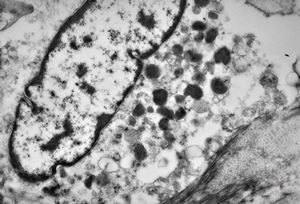 M,43y. | skin - susp. myelosis M,43y. | skin - susp. myelosis